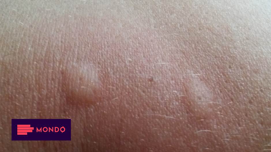 Evo šta da uradite ako vas ubode neki insekt Magazin Lifestyle