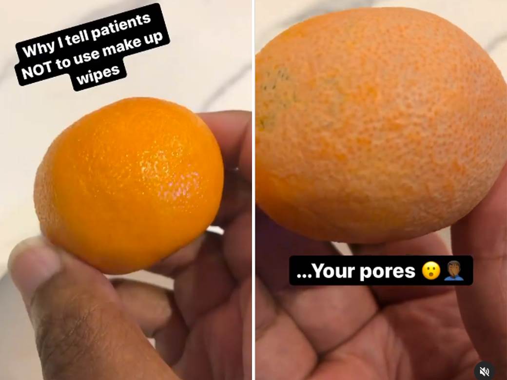  DERMATOLOG POKAZAO ZAŠTO NIKADA NE BI TREBALO DA SKIDATE ŠMINKU MARAMICOM: Video koji je zgrozio žene širom sveta! 