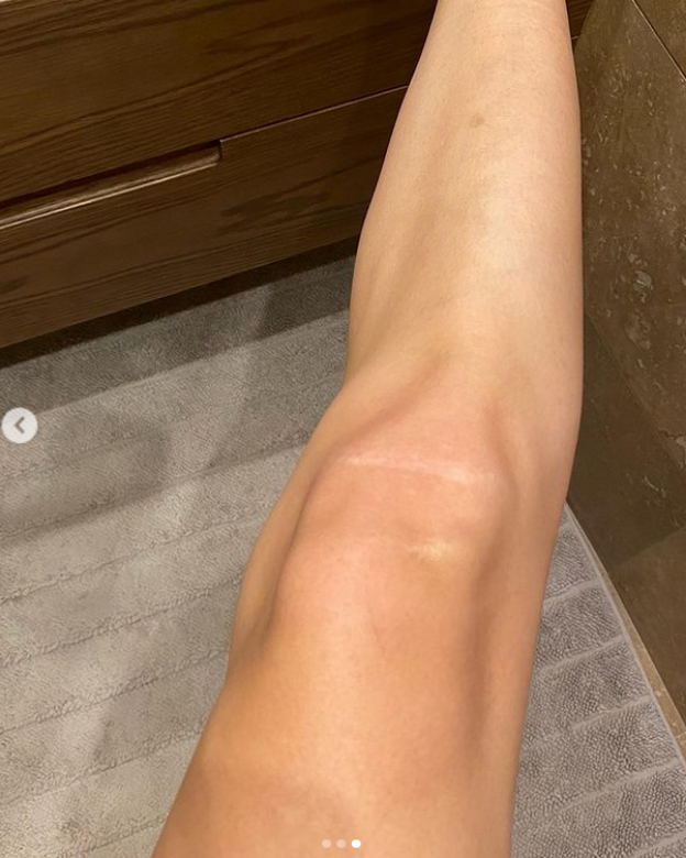  simptomi koji ukazuju da imate krvni ugrusak  