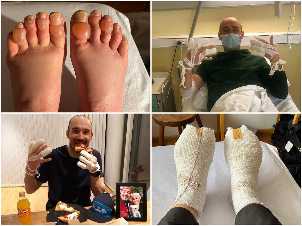  HOROR! PRETI IM AMPUTACIJA PRSTIJU ZBOG TRKE NA -28 STEPENI: Jezive fotografije i svedočenja - "Meni se zaledio penis" 