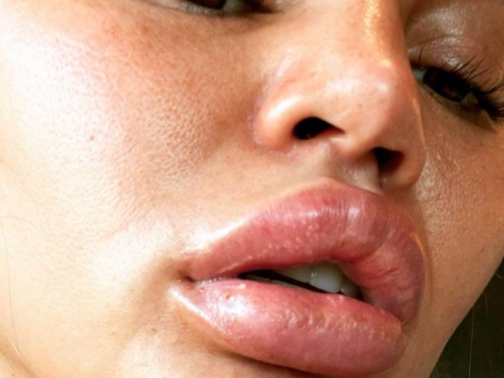  JELA SAM VOĆE, SLUČAJNO ZAGRIZLA KORU I OVO SE DESILO: Manekenka šokirala slikama usana, kao da ih je "pumpala"! (FOTO) 