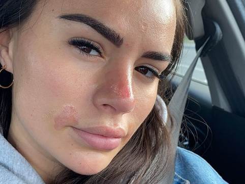  Naida Gadžo opekotine po licu nakon tretmana 