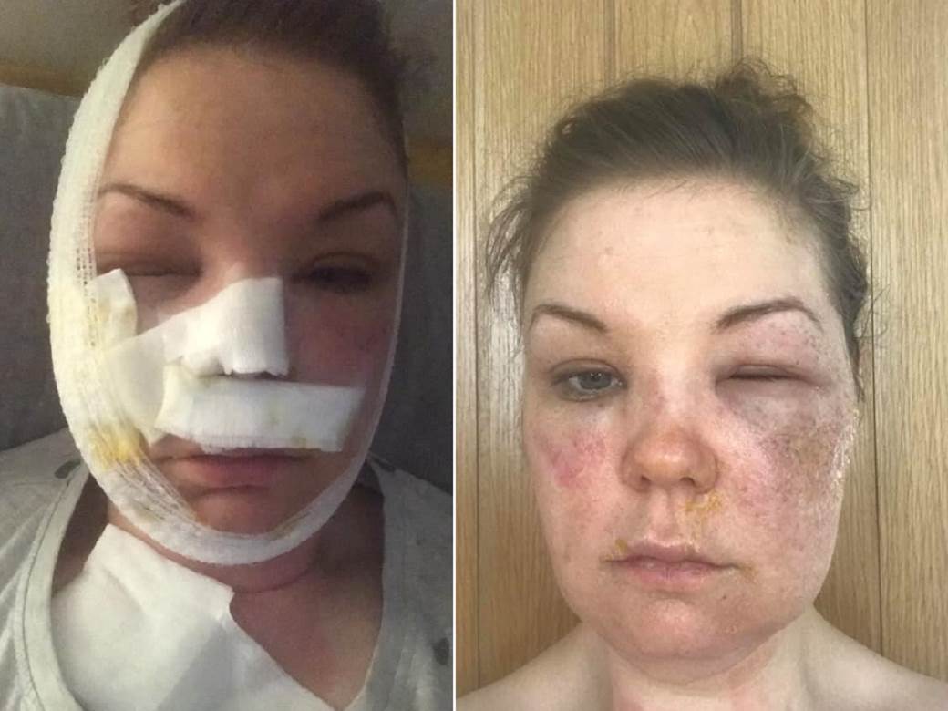  opekotine jaja doručak 