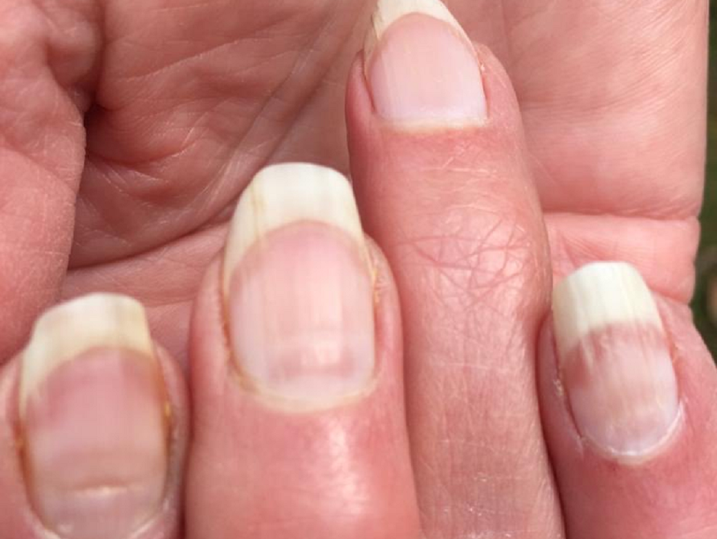  Evo kako izgled noktiju može da ukaže na moguća zdravstvena stanja 