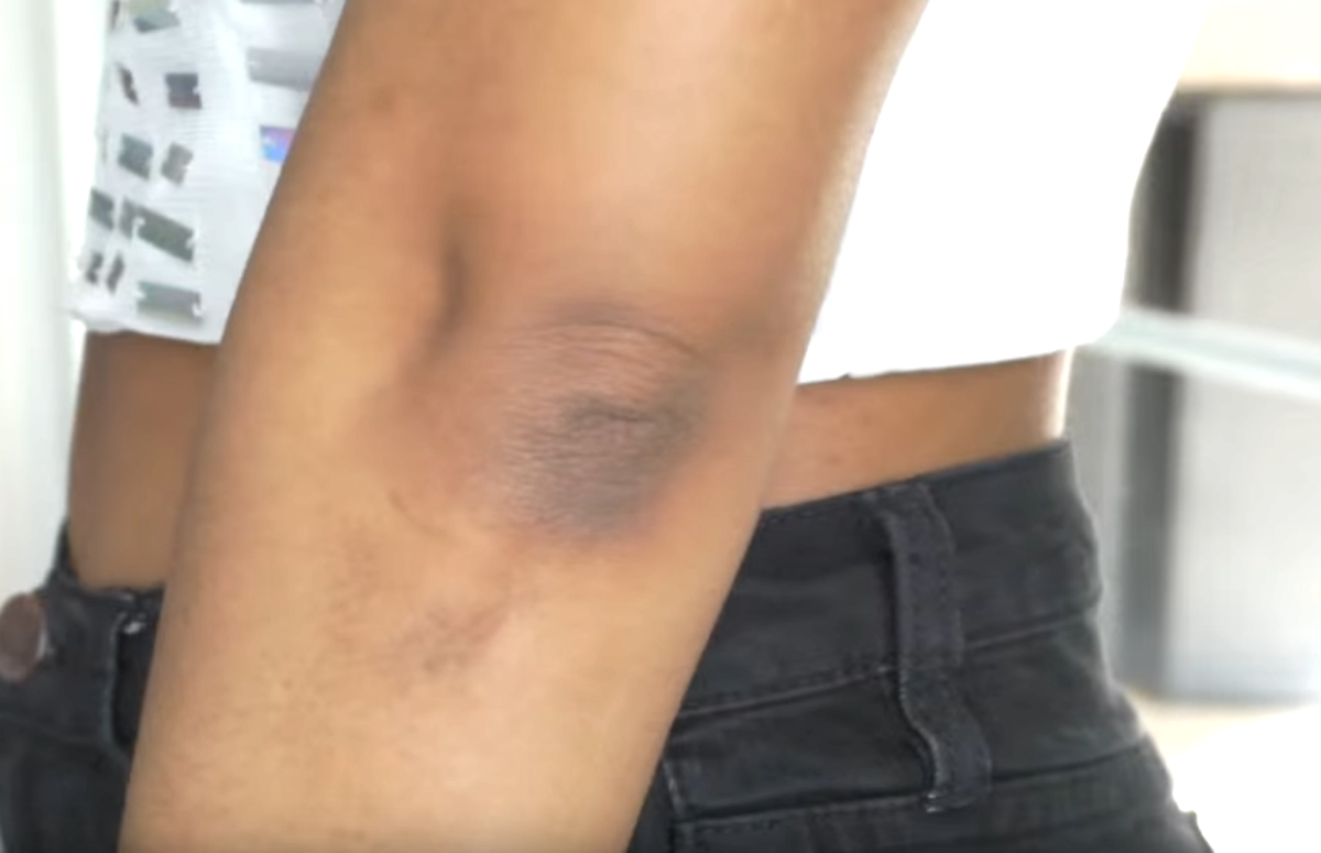  sta znaci kad potamni koza na laktovima 