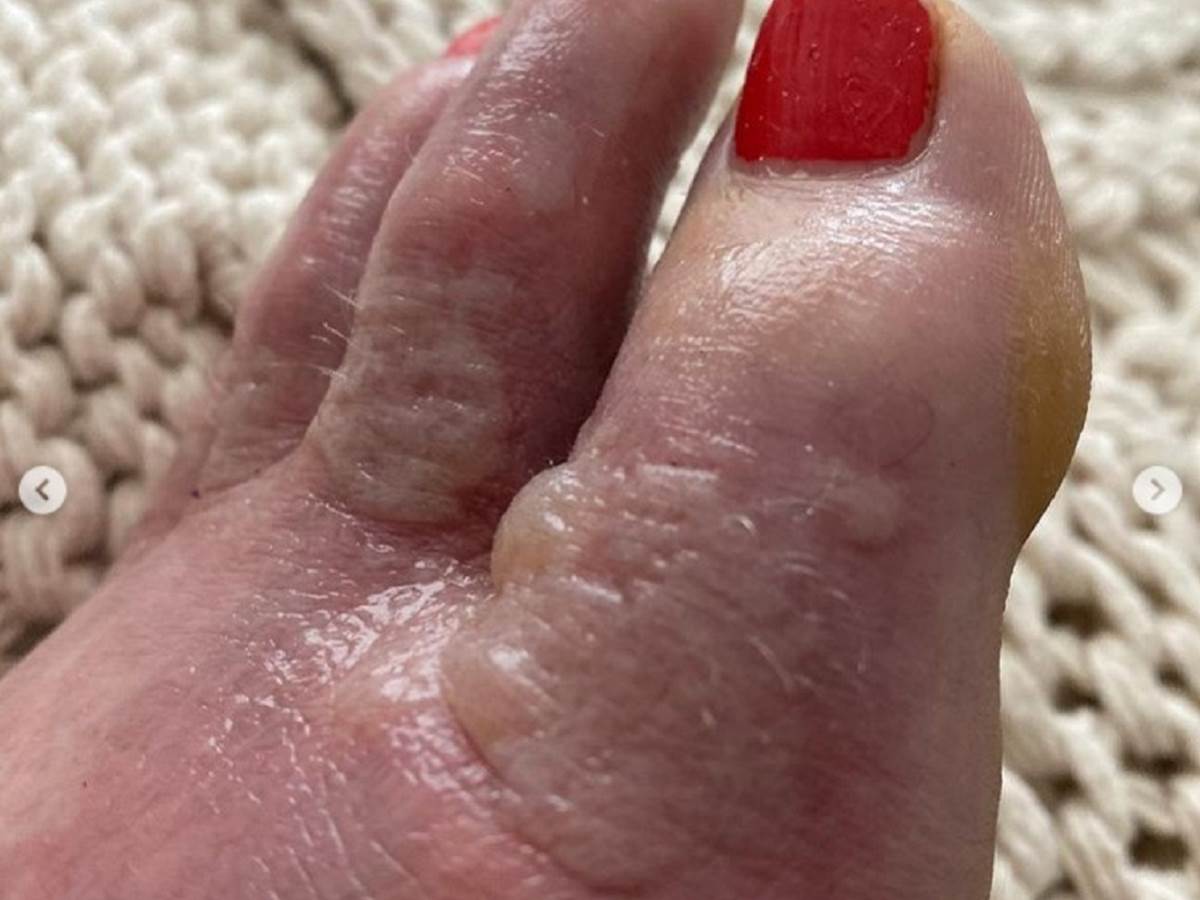  opekotine od prosutog koktela 