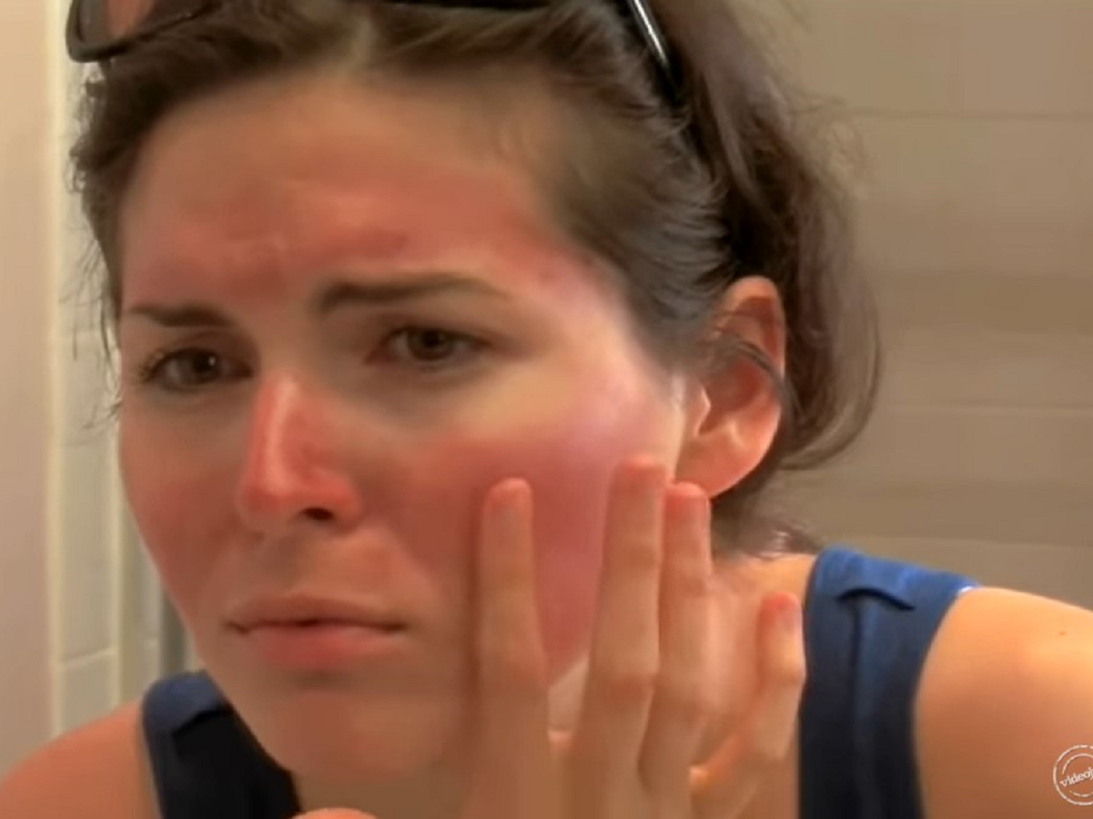  domaci ljekovi za opekotine 