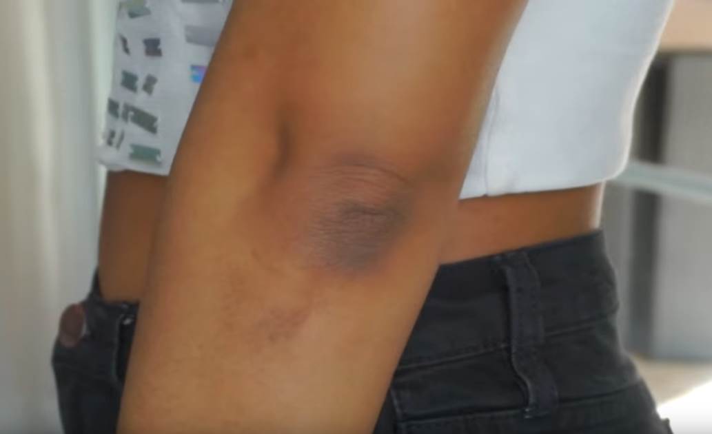  suvoca lakata bolesti 