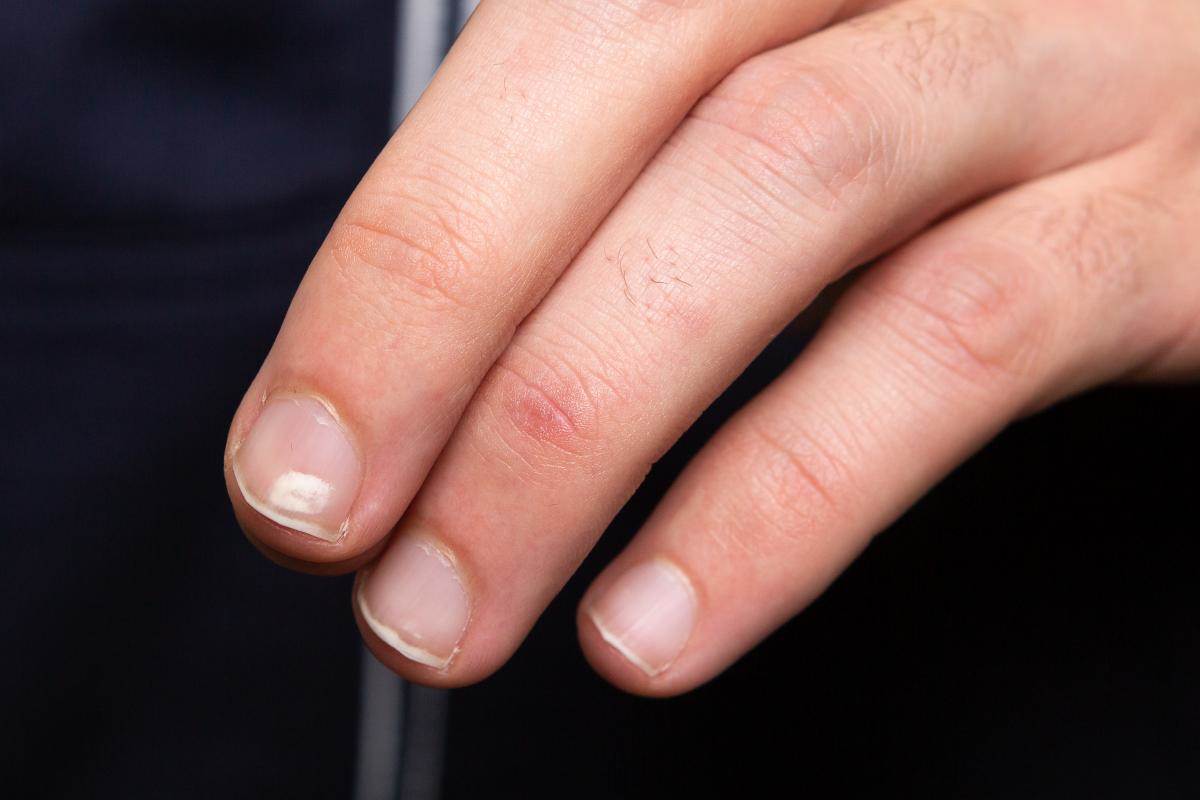  Šta znače bIJele tačkice na noktima 