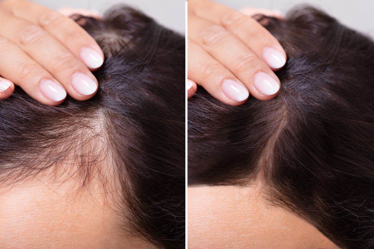  kako oporaviti kosu nakon hemoterapije 