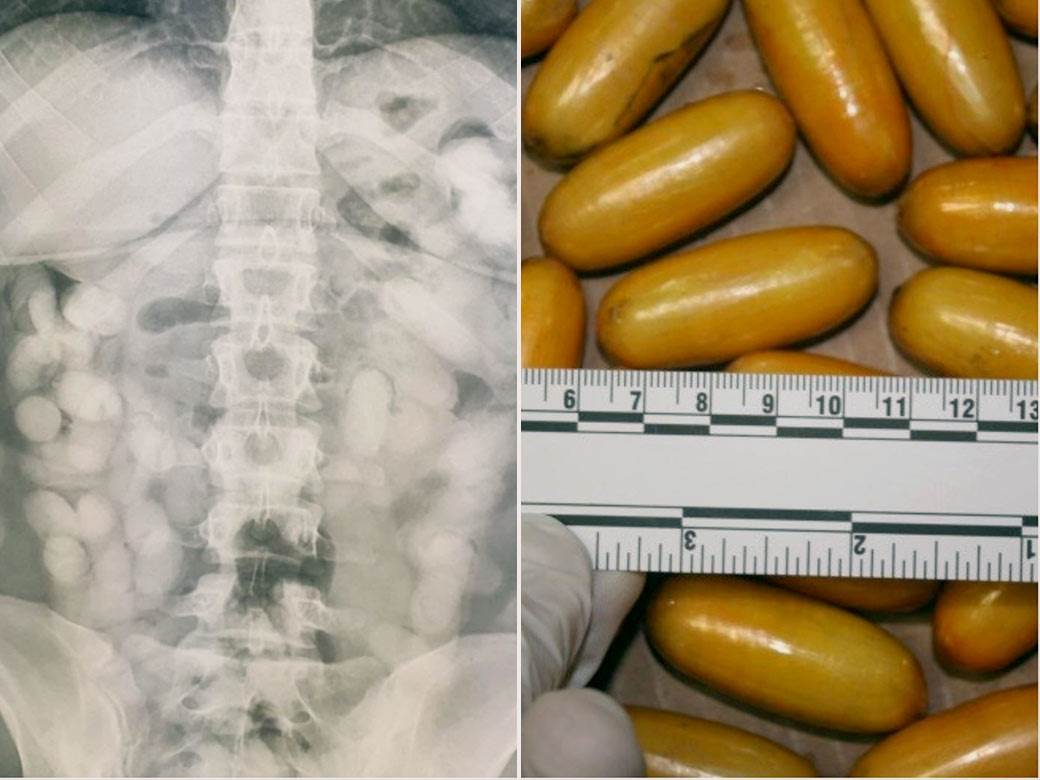  brazilka progutala 76 kapsula kokaina 