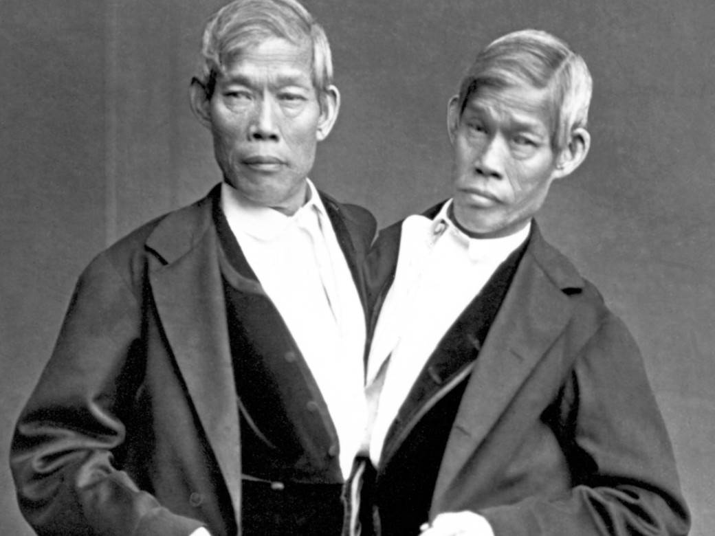  prvi sijamski blizanci 