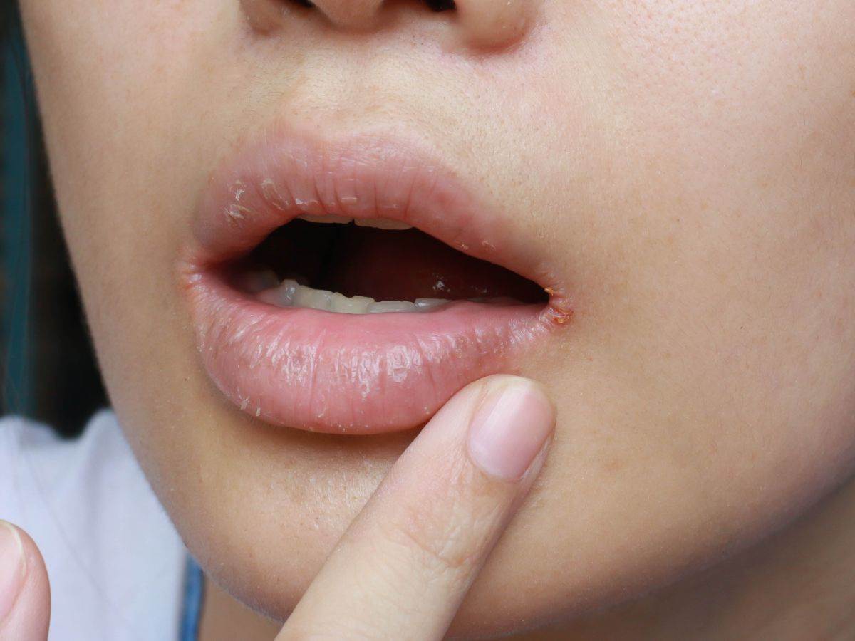  ispucale usne simptomi 