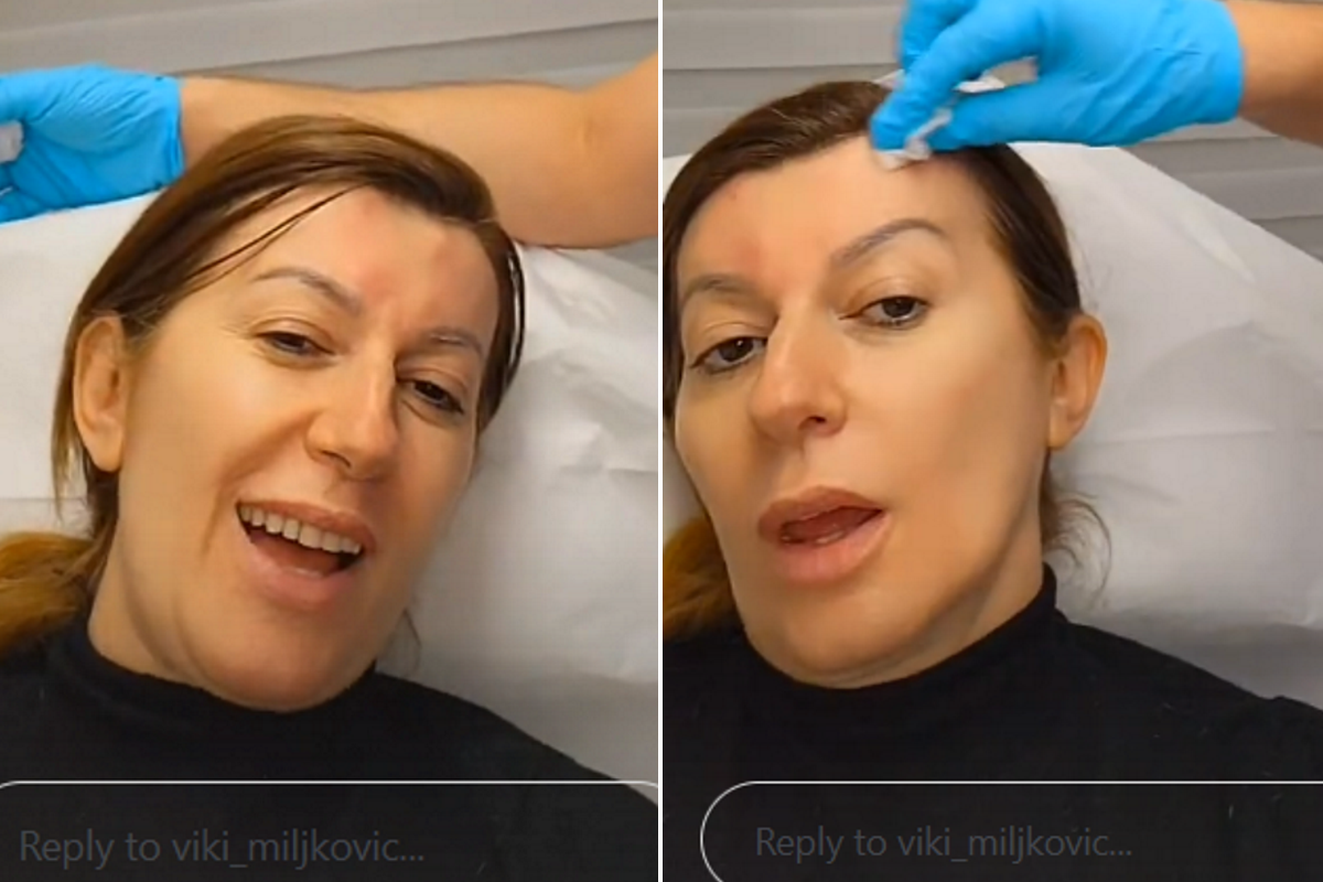   Viki Miljković otkrila pratiocima da je išla na tretman botoksom 