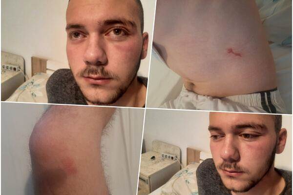  Još jedan mladić srpske nacionalnosti je napadnut na KiM oko 2 sata iza ponoći 