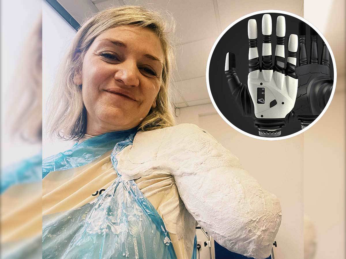  Sara će dobiti bioničku ruku vrijednu skoro 300.000 eura 