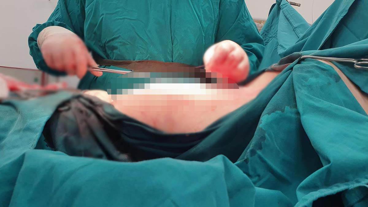  Ženi izvadili tumor od 20kg 