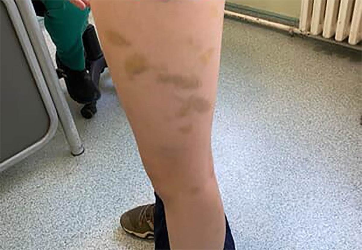  Vršnjak pretukao motkom drugara na rekreativnoj na Divčibarama 