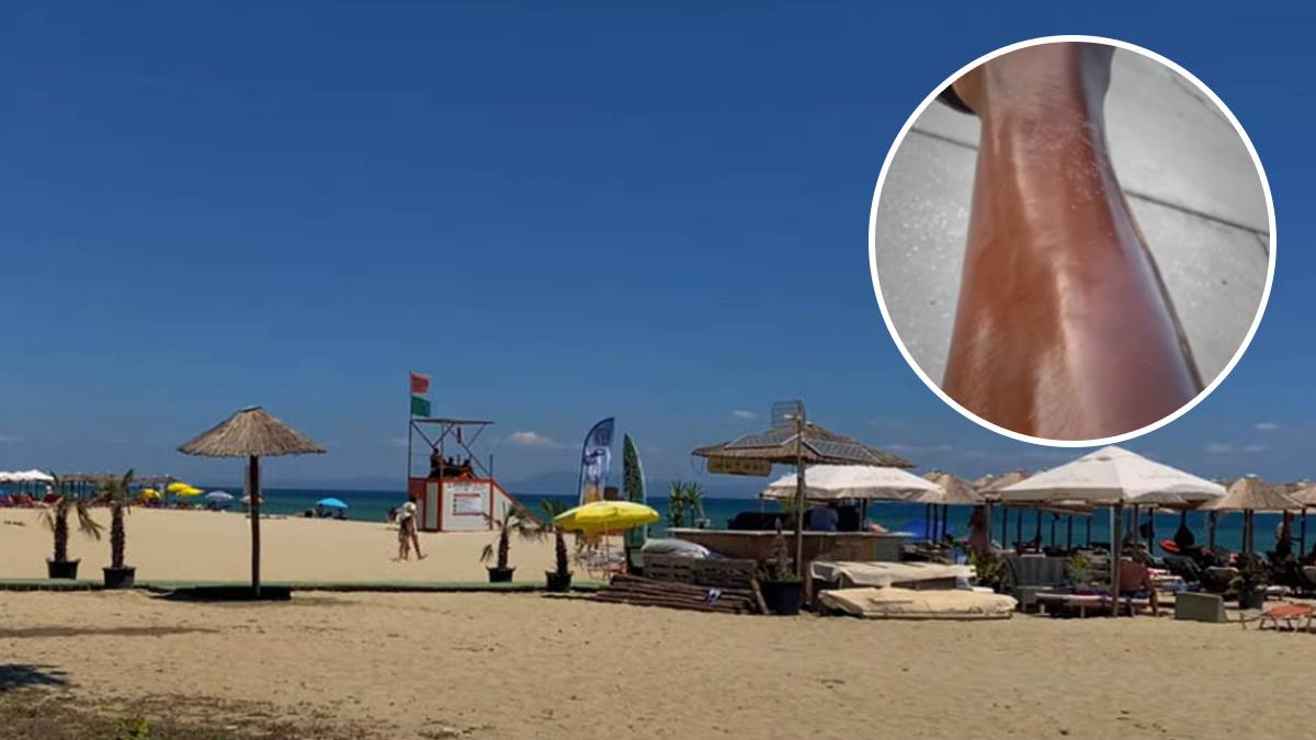   Kroz smeh pokazao jezivu kožu posle letovanja 