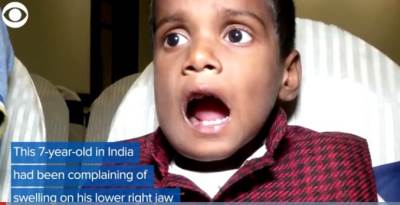  DEČAKU IZ INDIJE UKLONJENO 526 ZUBA!  