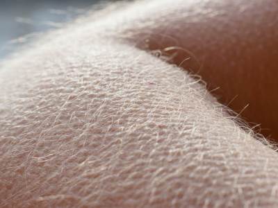  Koza-najezena-zbog-cega-se-jezimo 