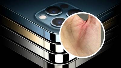  iPhone 12 SEČE KOŽU KORISNIKA 