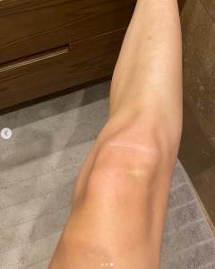  sve o multipla skrelozi 