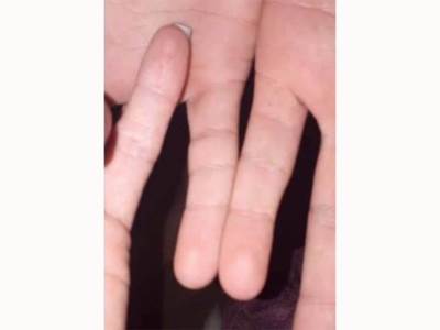  cetiri prevoja na prstima neobicna pojava na dlanovima 