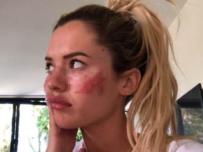  unakazeno lice ucesnice velikog brata 