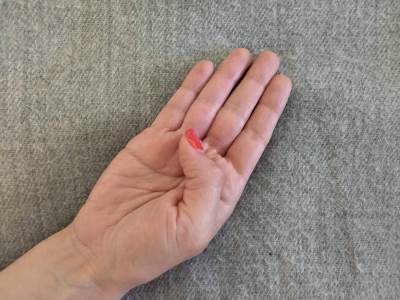  medicinsko objašnjenje za svrab na dlanu 