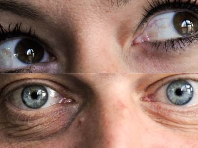  znak u oku može da otkrije opasno zdravstveno stanje 