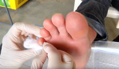  zuljevi na stopalima savjeti 