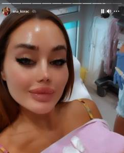  ana korac silikoni botoks 