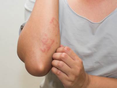  simptomi bolesti imunitete 