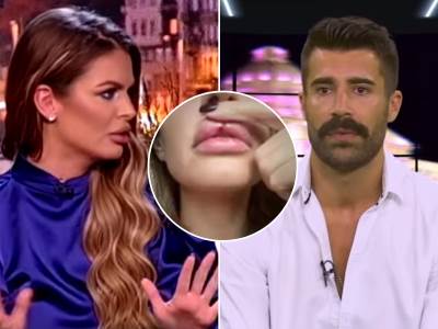  rialda povrede rascijepane usne 