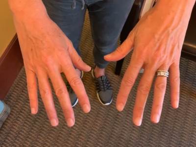  Promena na vrhovima prstiju može da bude znak alarma - simptom karcinoma. 