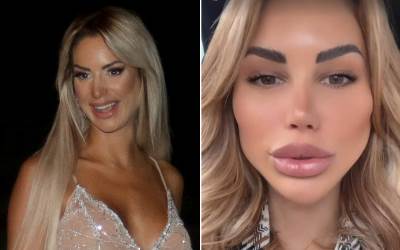  iva grguric prije i posle operacija 