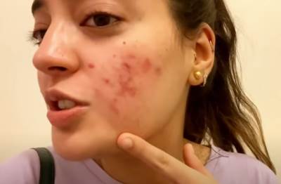  kako se izljeciti od akni 