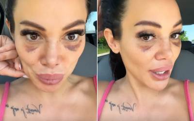  Tamara Đurić plastična operacija 