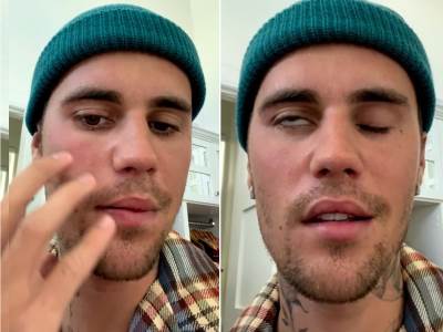   Džastinu Biberu pola lica paralisano 