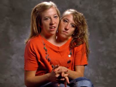  Sijamske bliznakinje Ebi i Britani sada imaju 32 godine 