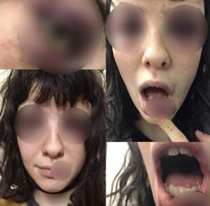  Pretucena ruskinja na instagramu podijelila svoje povrede 