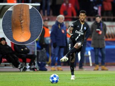  Kimpembe pokazao svoju povredu 