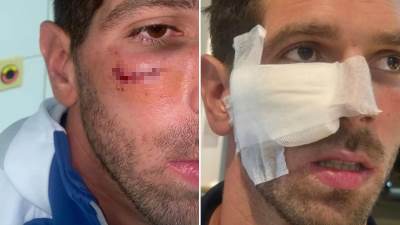  Uznemirujuće scene u Hrvatskoj: Kovačić završio sa krvavim i otvorenim licem, sudija nije dao crveni karton 