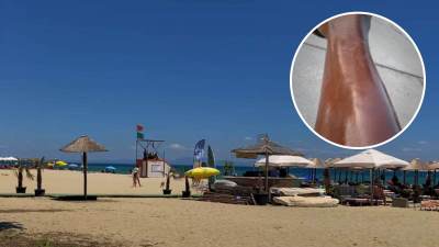   Kroz smeh pokazao jezivu kožu posle letovanja 