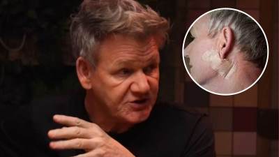  Gordon Remzi pokazao sliku nakon operacije tumora 