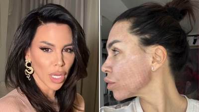  Kaja Ostojić pokazala crveno lice sa ožiljcima pa zabrinula fanove 