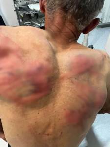 Brutalno pretučen kod Zubinog Potoka: Tvrdi da su ga policajci vezali za drvo tražeći da prizna ratn 